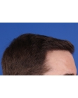 After Hair Transplant&nbsp;Hairlines